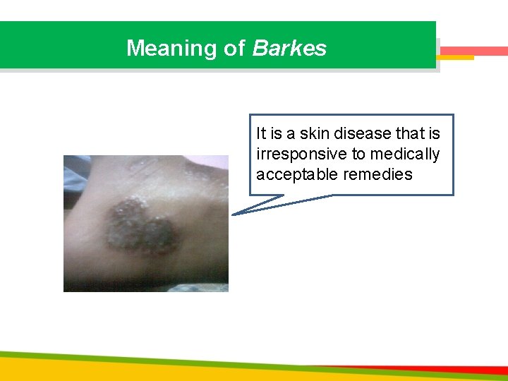 Meaning of Barkes It is a skin disease that is irresponsive to medically acceptable