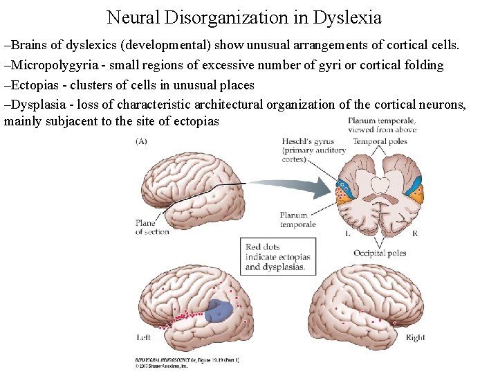 Neural Disorganization in Dyslexia –Brains of dyslexics (developmental) show unusual arrangements of cortical cells.