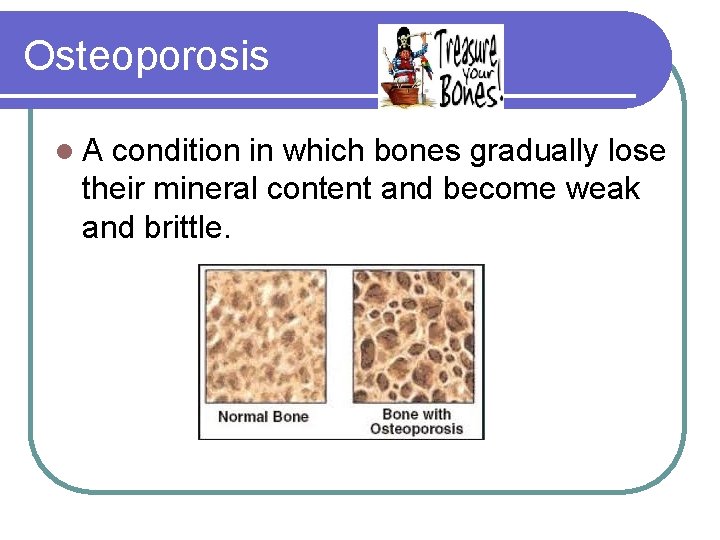 Osteoporosis l. A condition in which bones gradually lose their mineral content and become