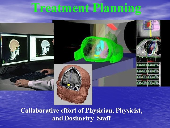 Treatment Planning Collaborative effort of Physician, Physicist, and Dosimetry Staff 
