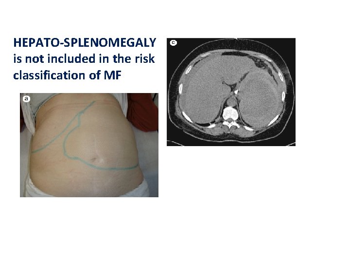 HEPATO-SPLENOMEGALY is not included in the risk classification of MF 