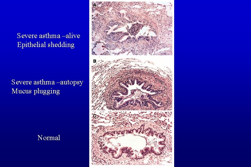 Severe asthma –alive Epithelial shedding Severe asthma –autopsy Mucus plugging Normal 