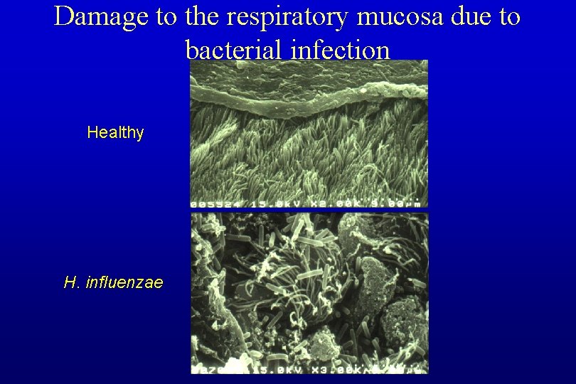 Damage to the respiratory mucosa due to bacterial infection Healthy H. influenzae 