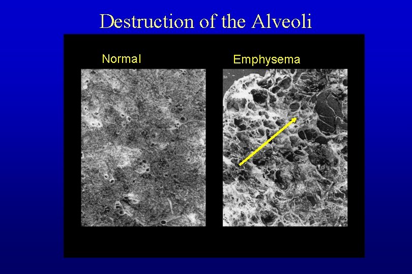 Destruction of the Alveoli Normal Emphysema 