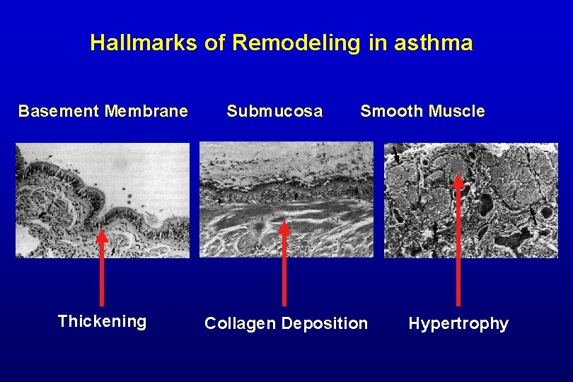 Hallmarks of Remodeling in asthma Basement Membrane Thickening Submucosa Smooth Muscle Collagen Deposition Hypertrophy