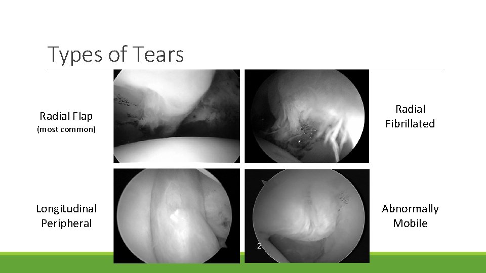 Types of Tears Radial Flap (most common) Radial Fibrillated Longitudinal Peripheral Abnormally Mobile 