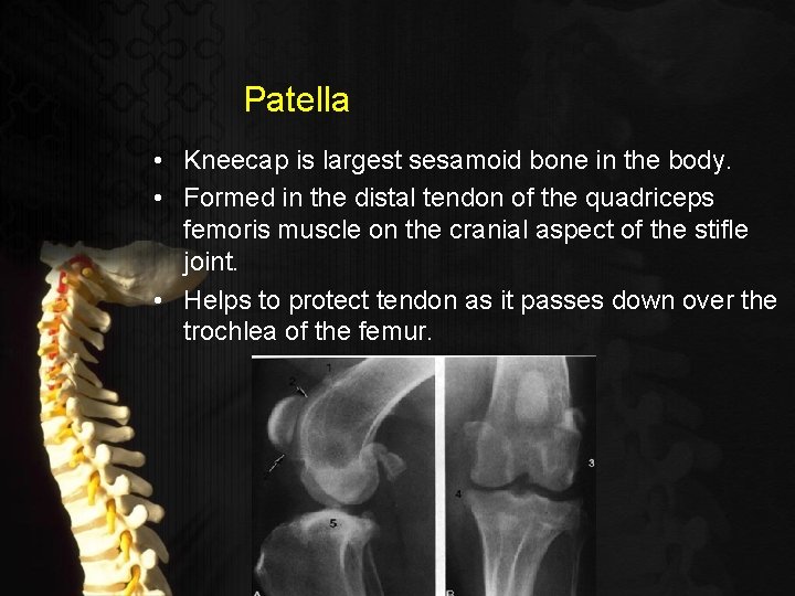 Patella • Kneecap is largest sesamoid bone in the body. • Formed in the