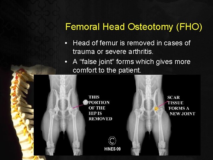 Femoral Head Osteotomy (FHO) • Head of femur is removed in cases of trauma