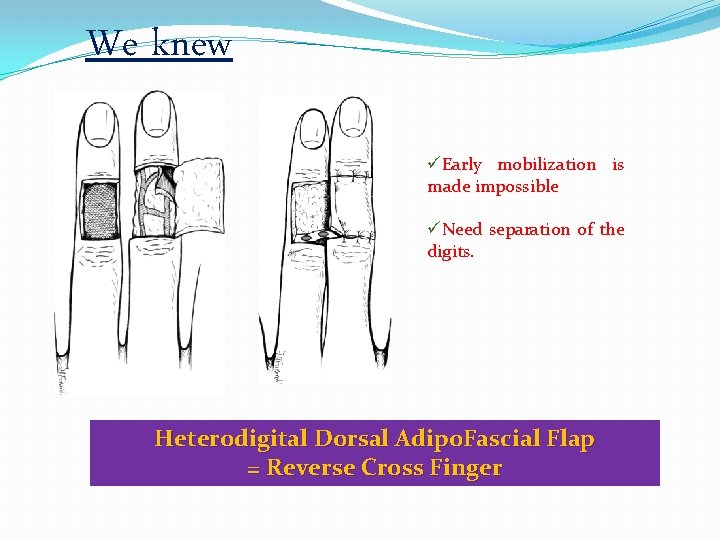 We knew üEarly mobilization is made impossible üNeed separation of the digits. Heterodigital Dorsal