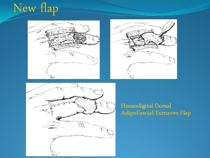 New flap Homodigital Dorsal Adipo. Fascial Turnover Flap 