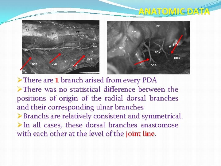 ANATOMIC DATA ØThere are 1 branch arised from every PDA ØThere was no statistical