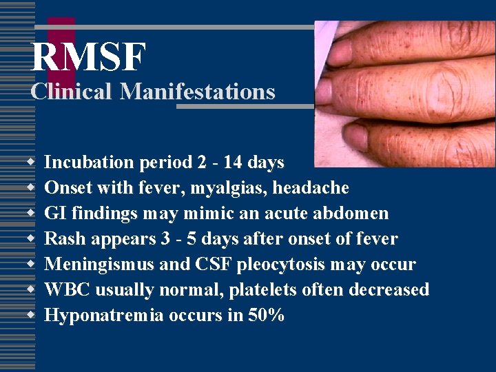 RMSF Clinical Manifestations w w w w Incubation period 2 - 14 days Onset