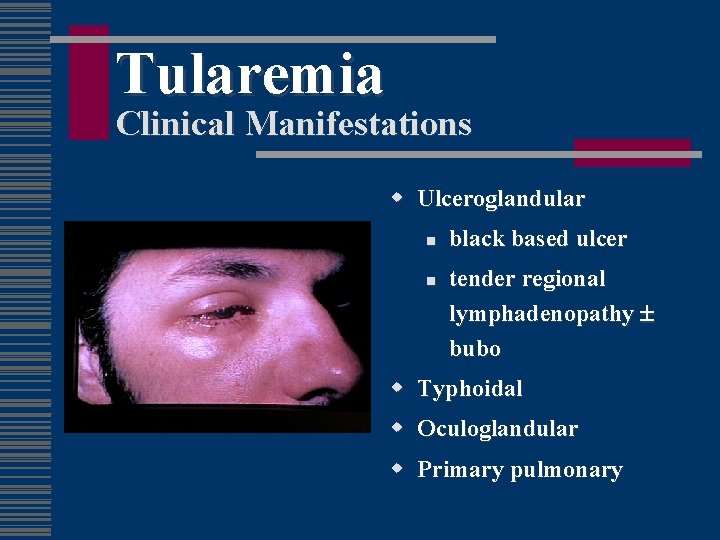 Tularemia Clinical Manifestations w Ulceroglandular n n black based ulcer tender regional lymphadenopathy bubo