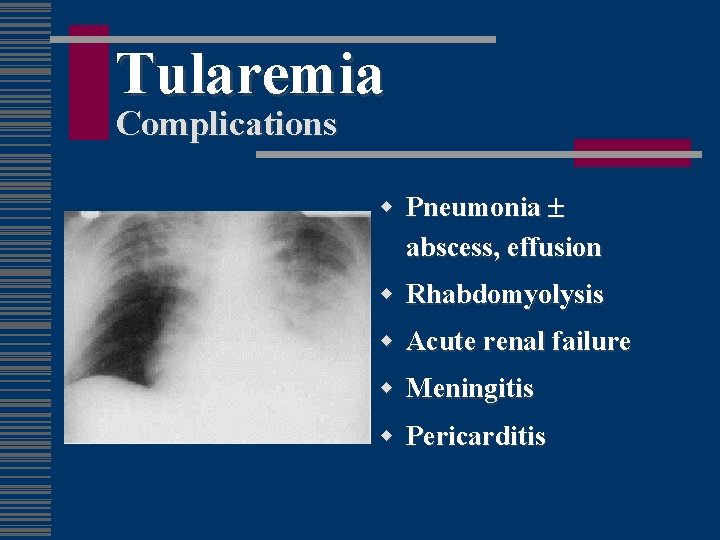 Tularemia Complications w Pneumonia abscess, effusion w Rhabdomyolysis w Acute renal failure w Meningitis