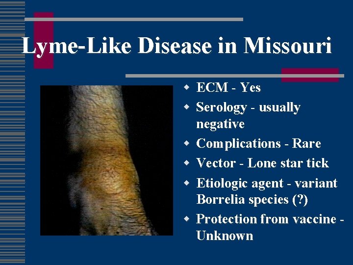 Lyme-Like Disease in Missouri w ECM - Yes w Serology - usually negative w