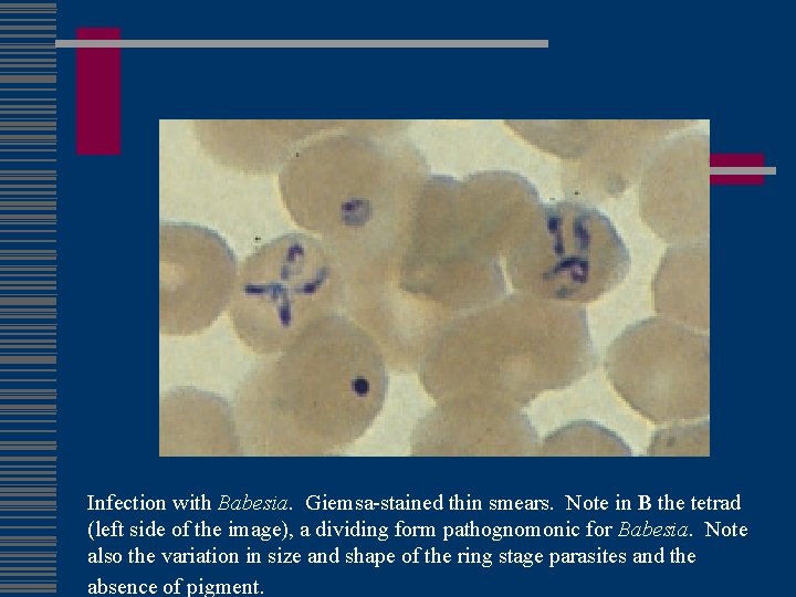 Infection with Babesia. Giemsa-stained thin smears. Note in B the tetrad (left side of