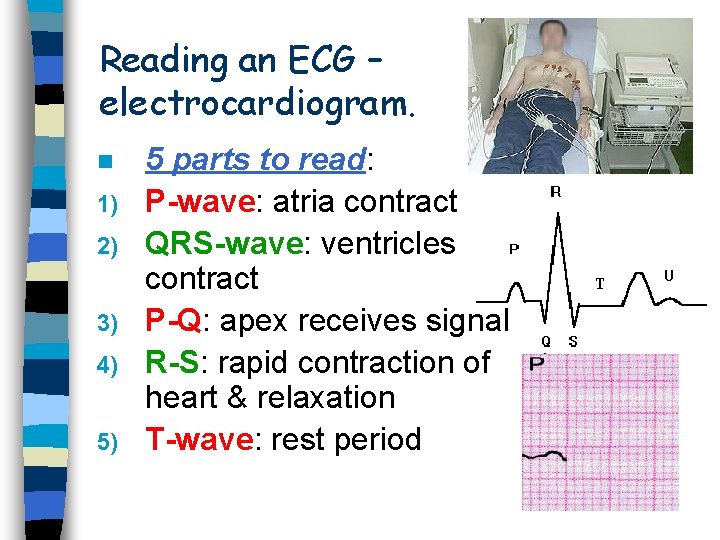 Reading an ECG – electrocardiogram. n 1) 2) 3) 4) 5) 5 parts to