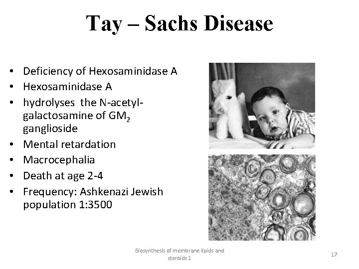 Tay – Sachs Disease • Deficiency of Hexosaminidase A • hydrolyses the N-acetylgalactosamine of