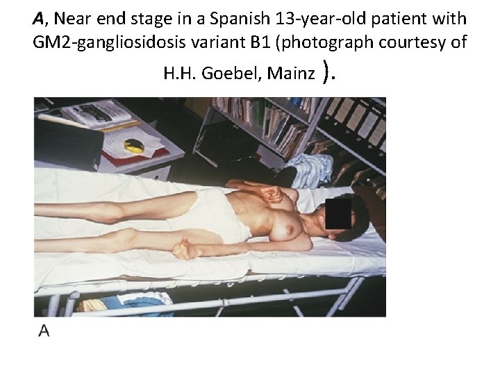 A, Near end stage in a Spanish 13 -year-old patient with GM 2 -gangliosidosis