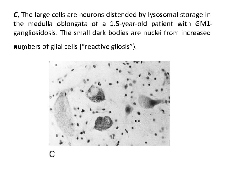C, The large cells are neurons distended by lysosomal storage in the medulla oblongata