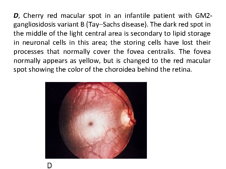 D, Cherry red macular spot in an infantile patient with GM 2 gangliosidosis variant