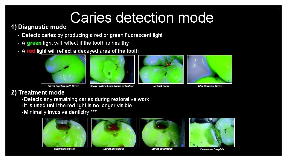 Caries detection mode 1) Diagnostic mode - Detects caries by producing a red or