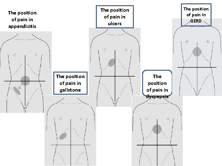 The position of pain in GERD The position of pain in ulcers The position