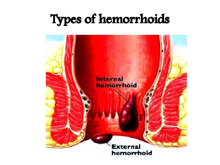 Types of hemorrhoids 