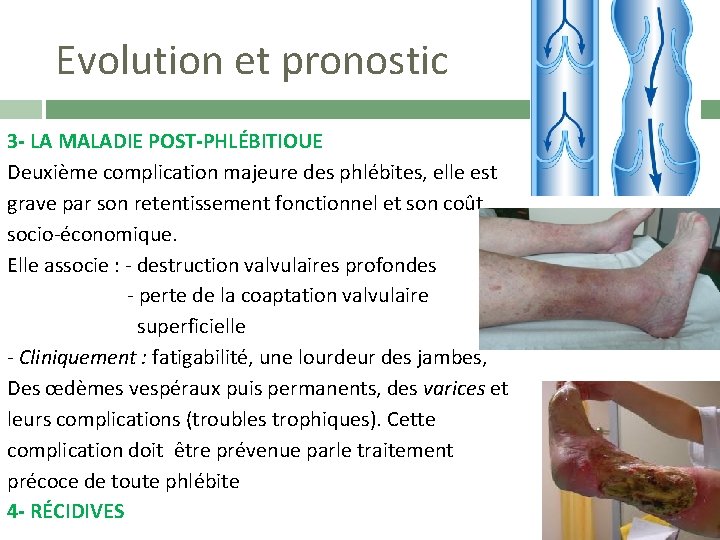 Evolution et pronostic 3 - LA MALADIE POST-PHLÉBITIOUE Deuxième complication majeure des phlébites, elle