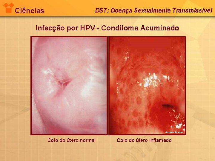 Ciências DST: Doença Sexualmente Transmissível Infecção por HPV - Condiloma Acuminado Arquivo do autor