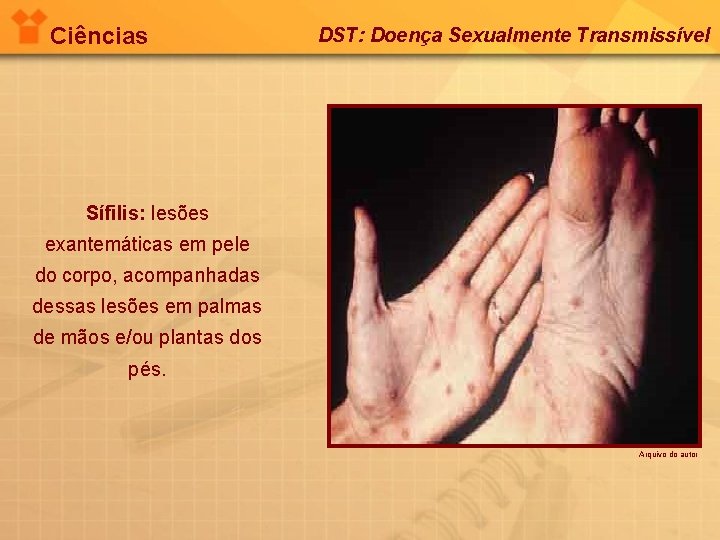 Ciências DST: Doença Sexualmente Transmissível Sífilis: lesões exantemáticas em pele do corpo, acompanhadas dessas