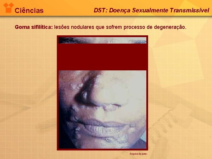 Ciências DST: Doença Sexualmente Transmissível Goma sifilítica: lesões nodulares que sofrem processo de degeneração.