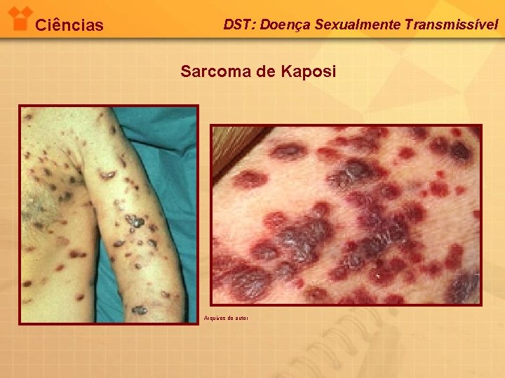 Ciências DST: Doença Sexualmente Transmissível Sarcoma de Kaposi Arquivos do autor 