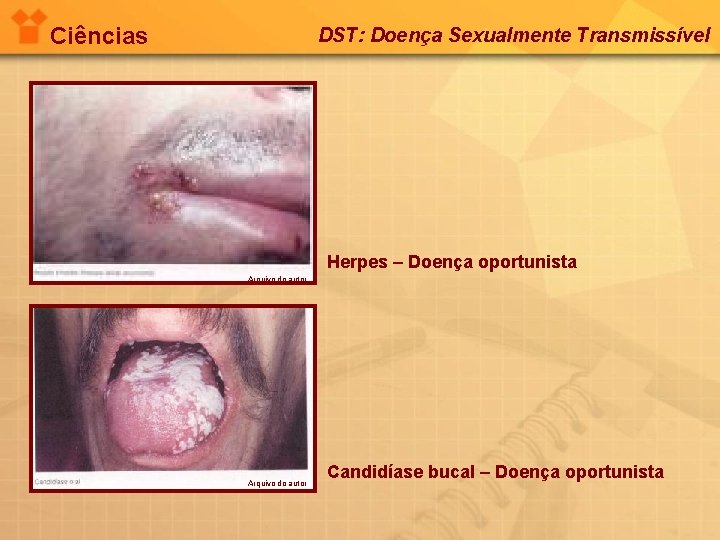 Ciências DST: Doença Sexualmente Transmissível Herpes – Doença oportunista Arquivo do autor Candidíase bucal