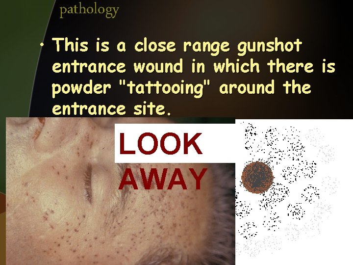 pathology • This is a close range gunshot entrance wound in which there is