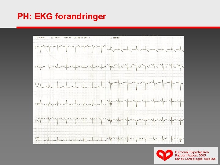 PH: EKG forandringer Pulmonal Hypertension Rapport August 2005 Dansk Cardiologisk Selskab 