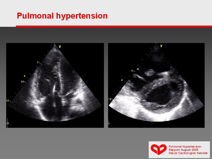 Pulmonal hypertension Pulmonal Hypertension Rapport August 2005 Dansk Cardiologisk Selskab 
