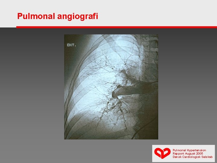 Pulmonal angiografi Pulmonal Hypertension Rapport August 2005 Dansk Cardiologisk Selskab 