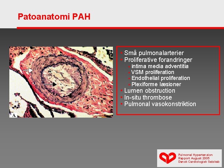 Patoanatomi PAH • Små pulmonalarterier • Proliferative forandringer - intima media adventitia - VSM