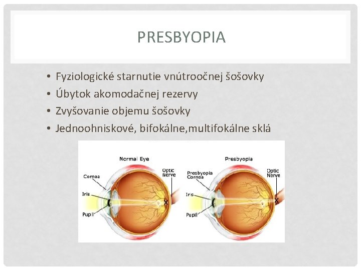 PRESBYOPIA • • Fyziologické starnutie vnútroočnej šošovky Úbytok akomodačnej rezervy Zvyšovanie objemu šošovky Jednoohniskové,