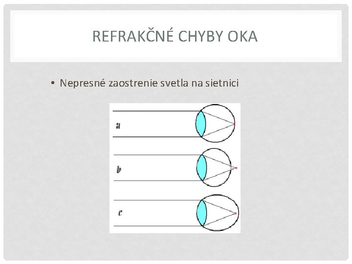 REFRAKČNÉ CHYBY OKA • Nepresné zaostrenie svetla na sietnici 