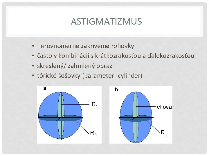 ASTIGMATIZMUS • • nerovnomerné zakrivenie rohovky často v kombinácii s krátkozrakosťou a ďalekozrakosťou skreslený/