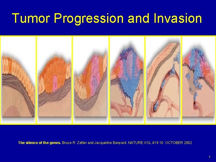 Tumor Progression and Invasion The silence of the genes. Bruce R. Zetter and Jacqueline