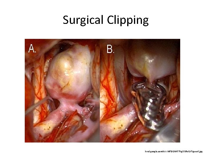 Surgical Clipping knol. google. com/k/-/-/MF 8 Qh. HFP/g. UO 6 v. Q/Figure 4. jpg