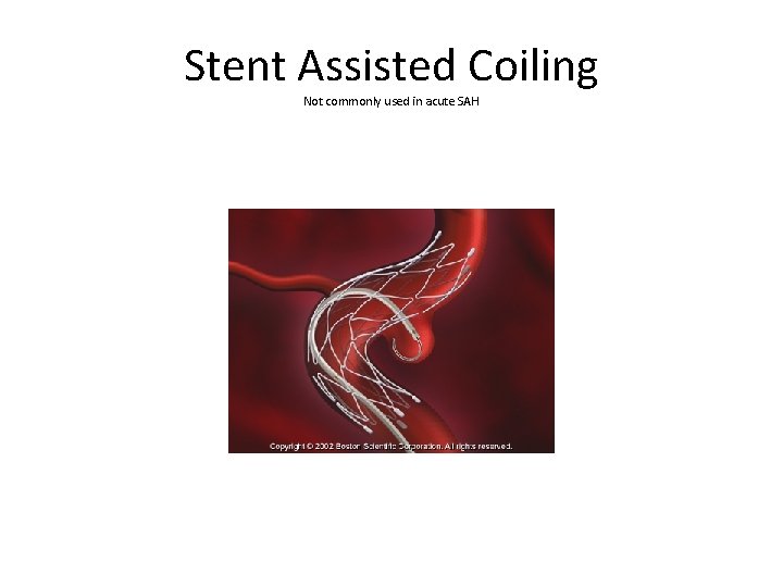 Stent Assisted Coiling Not commonly used in acute SAH 