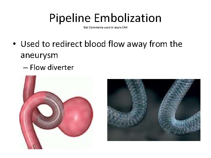 Pipeline Embolization Not Commonly used in acute SAH • Used to redirect blood flow