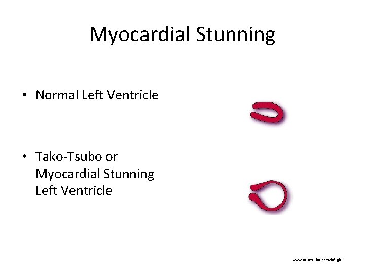 Myocardial Stunning • Normal Left Ventricle • Tako-Tsubo or Myocardial Stunning Left Ventricle www.