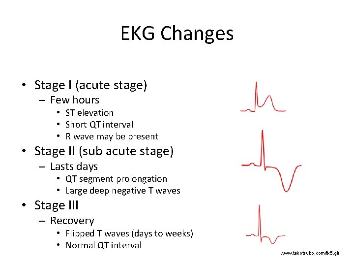 EKG Changes • Stage I (acute stage) – Few hours • ST elevation •