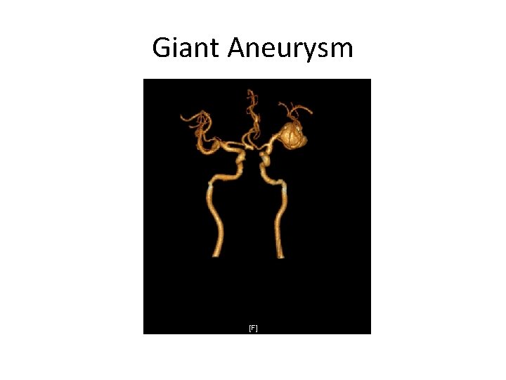 Giant Aneurysm 