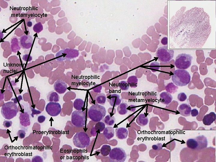 Neutrophilic metamyelocyte Unknown nuclei Neutrophilic myelocyte Neutrophilic band Neutrophilic metamyelocyte Proerythroblast Orthochromatophilic erythroblast Eosinophils